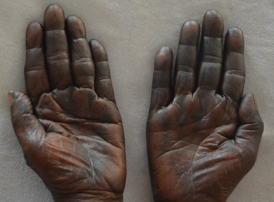 Blotchy greyish-black pigmentation over palms.